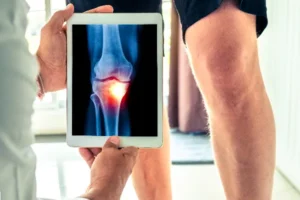 Diagnosing Knee Osteoarthritis