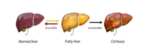 
MASH and Liver Disease Stages: Where It Fits in the Progression
